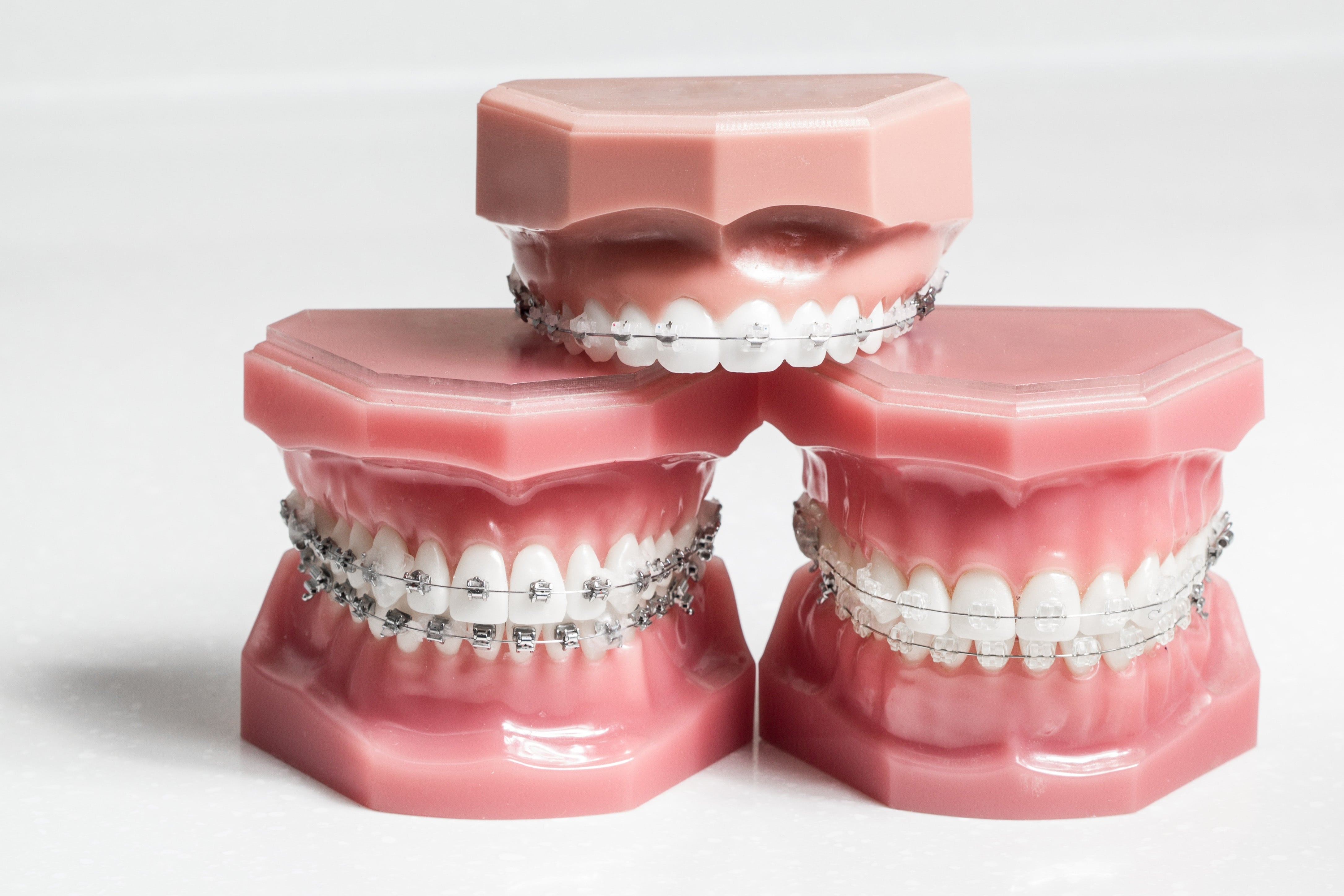 How Do Braces Work? SOUTH COAST DENTAL
