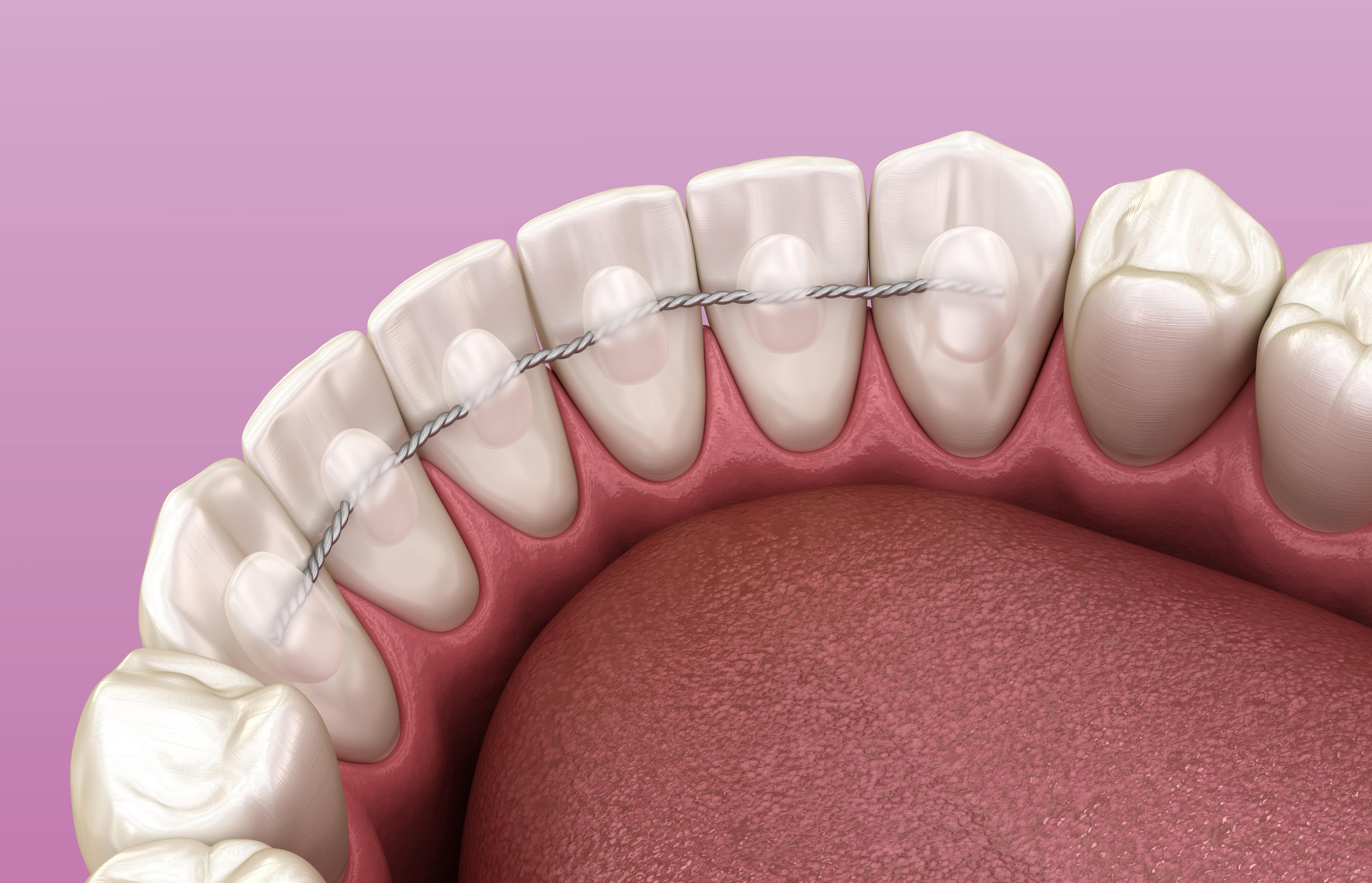 How Do Braces Work? SOUTH COAST DENTAL